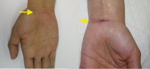 carpal tunnel release scar