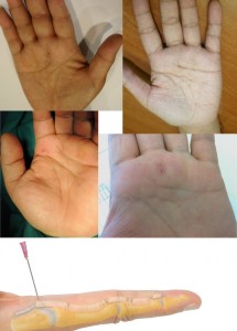 trigger_finger_彈弓指