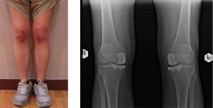 unicondylar knee replacement