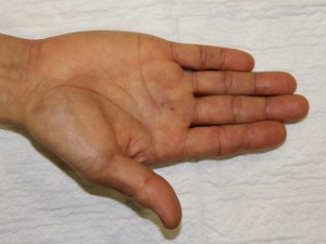 trigger finger